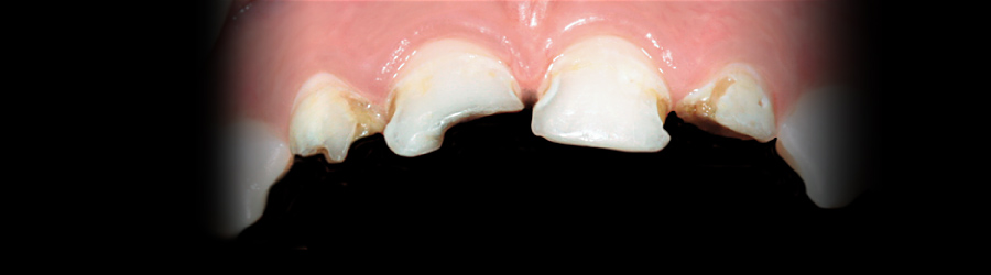 Лечение зубов детям под наркозом кемерово