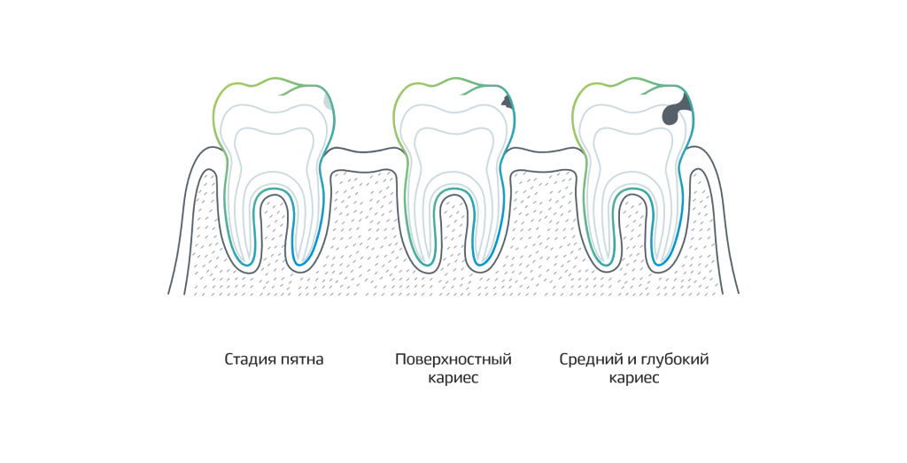 Глубокий кариес: что нужно знать, чтобы сохранить здоровье зубов