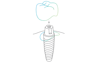 implantat.png