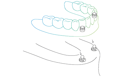 ball_protex_1.png